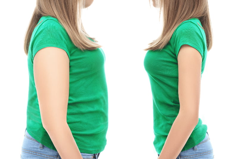 Gastric Sleeve vs. Mini Bypass Which is Better for You