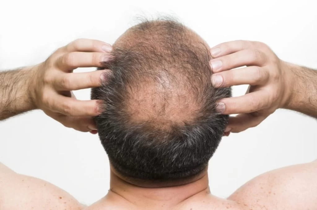 What is Stem Cell Hair Transplant